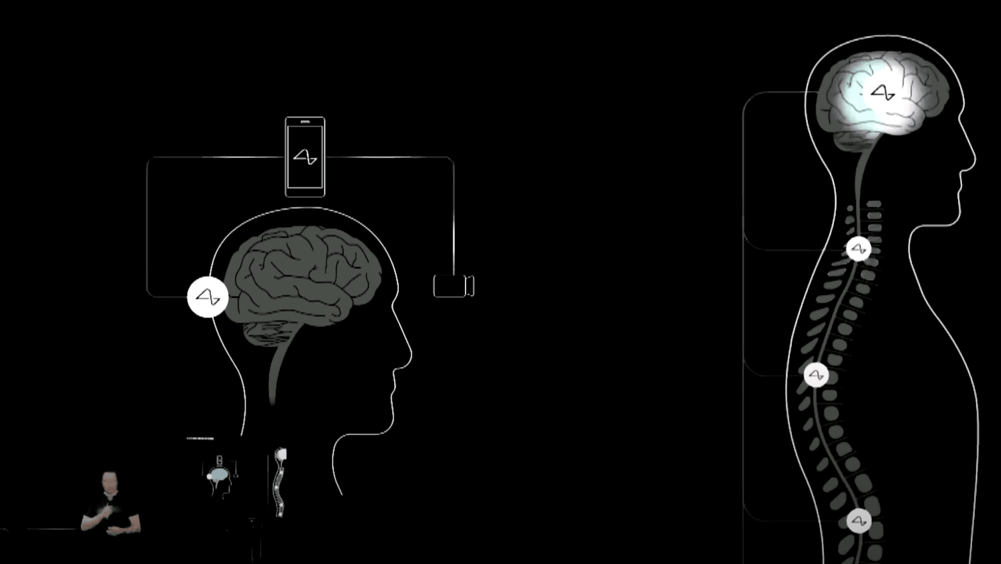 Neuralink გამოუშვებს ჩიპს მხედველობა დაკარგული ადამიანებისთვის