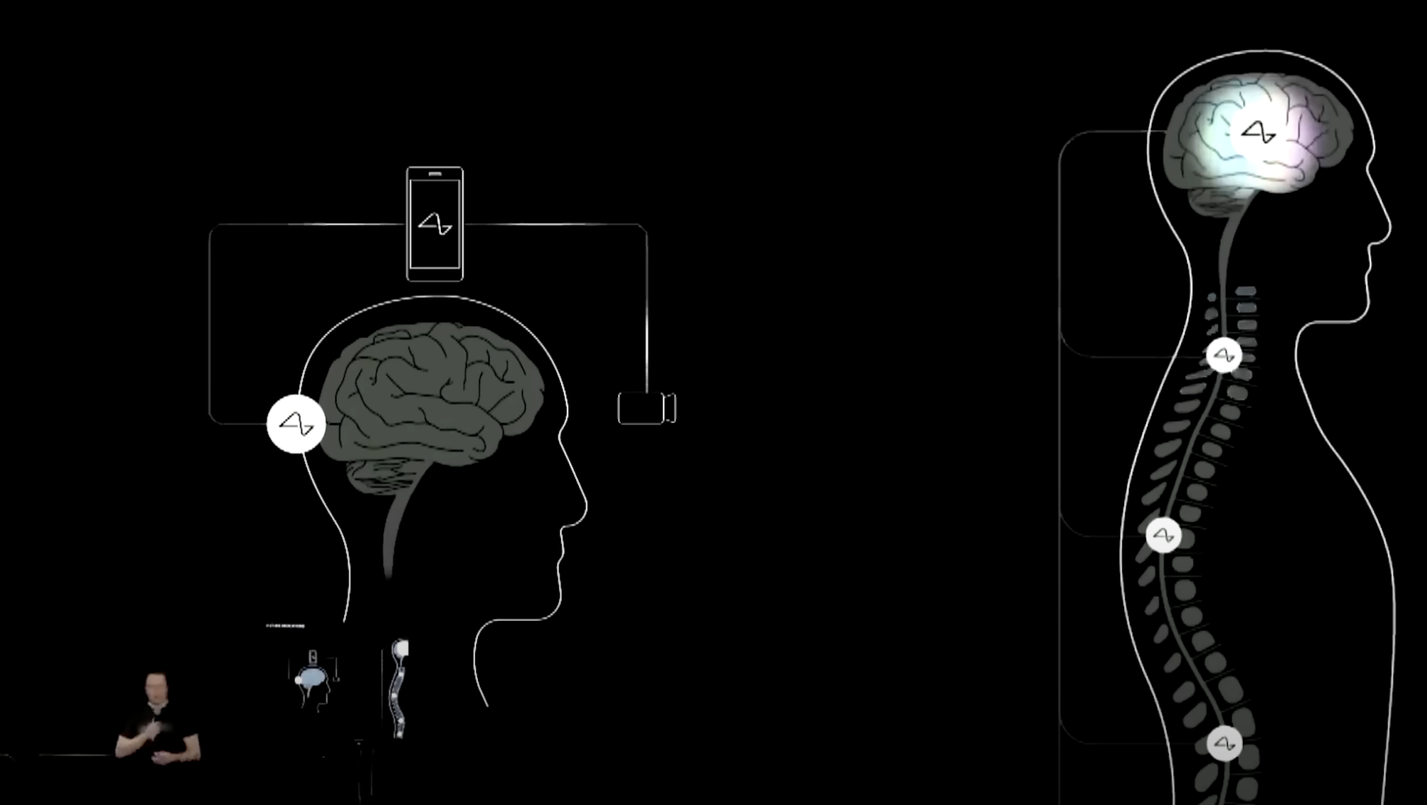 Neuralink გამოუშვებს ჩიპს მხედველობა დაკარგული ადამიანებისთვის