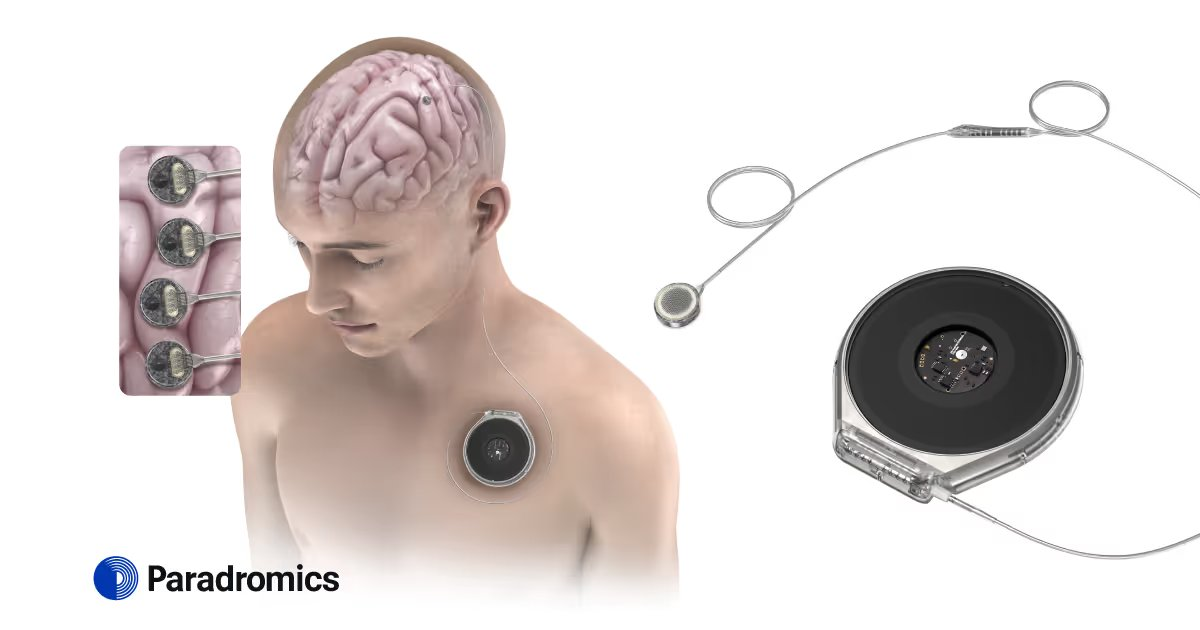 10 წუთი ტვინში: როგორ ჩატარდა Paradromics-ის იმპლანტის პირველი გამოცდა ადამიანზე?